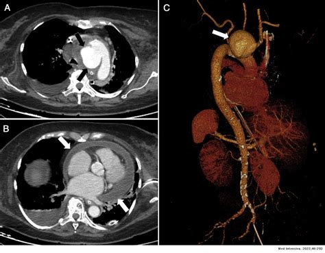 Mrsa Related Mycotic Pseudoaneurysm Of The Aortic Arch Medicina Intensiva