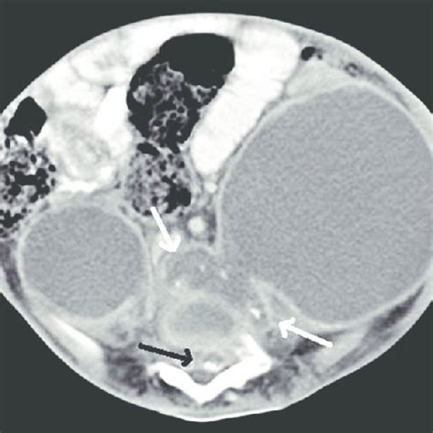 Ct Scan Of Abdomen And Lumbar Spine Axial Section Showing Bilateral