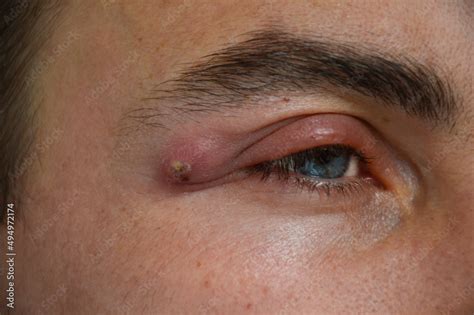 Boil A Strong Purulent Abscess In A Man Near The Eye Swelling From