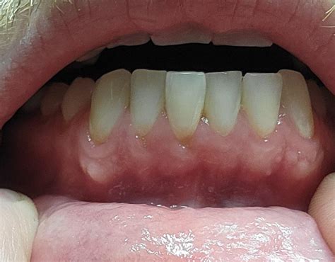 What Are These White Spots On My Gums Rdentalhygiene