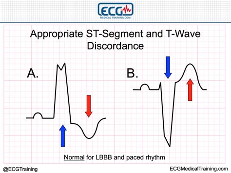 Making Sense Of Sgarbossas Criteria Chest Pain And Left Bundle