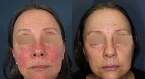 5 Things You May Not Know About Rosacea Arsc