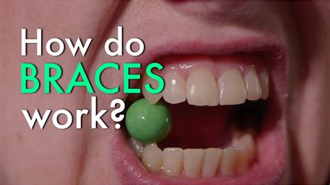 As the name suggests, this technology still no luck? How Do Braces Work? - YouTube