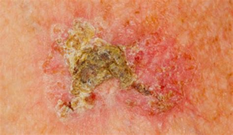 Actinic Keratosis Pictures Causes And Treatment Updated