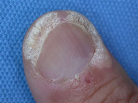 Photo Gallery Of Warts On Different Body Parts