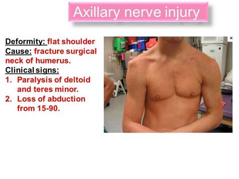 Axillary Nerve Injury Fr Note Axillary Nerve Supplies Deltoid
