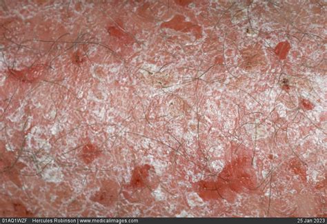 Stock Image Dermatology Psoriasis Close Up Of A Patch Of Red Dry