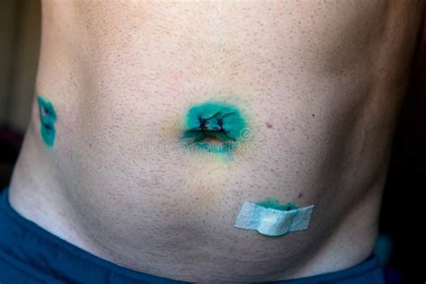 Medical Stitches On The Body After Laparoscopy Stock Photo Image Of