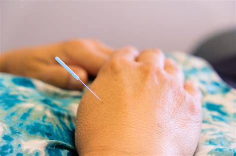 Medical Acupuncture | Adults | Children | Greenbrae, Marin County
