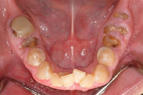 Severe Tooth Decay American College Of Prosthodontists