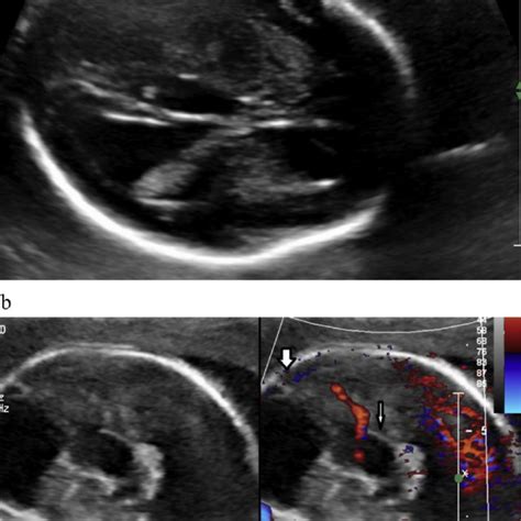 A 19 Weeks Fetus Referred For Dandy Walker Malformation A The Axial