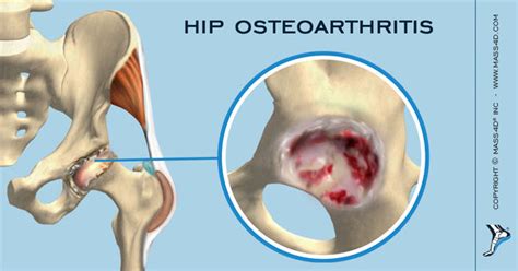 Understanding Hip Osteoarthritis Mass4d® Foot Orthotics