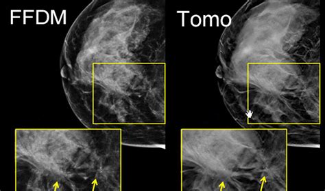 Guide Book Of 3d Tomosynthesis Mammography Sinomdt