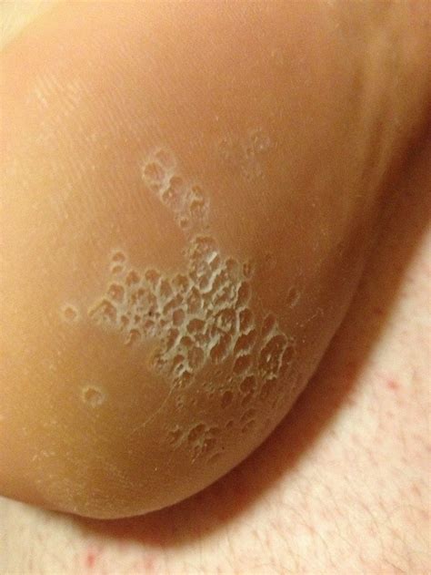 Small Circles Of Dry Skin Appearing On Sole Of Foot Health