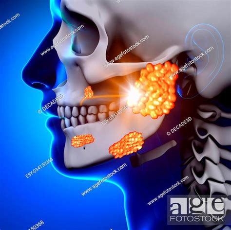 Mumps Parotid Gland Sickness Stock Photo Picture And Low Budget