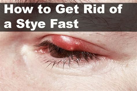 How To Get Rid Of A Stye Fast Vital Home Remedies Eye Stye Remedies