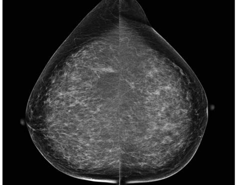 screening mammogram [image] eurekalert science news releases