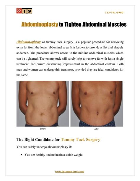 Abdominoplasty To Tighten Abdominal Muscles