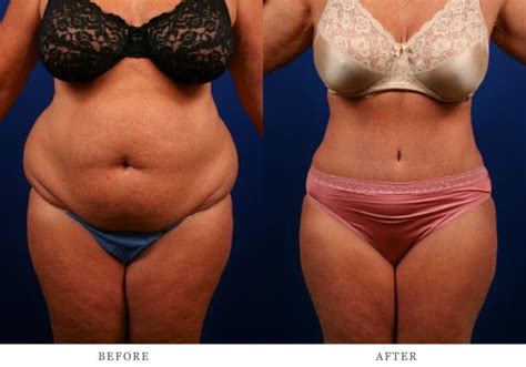 Pin By Bailey Cosmetic Surgery Vein On Before After Photos Tummy Tucks Tummy Tuck