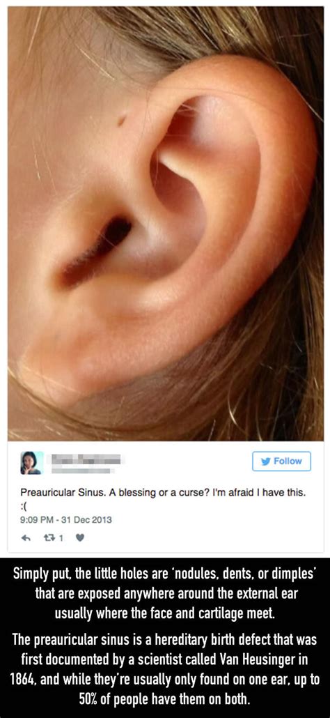 The Reason Why Some People Have Little Holes Above Their Ears Others
