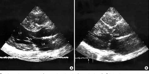 Figure 1 From Hypertrophic Obstructive Cardiomyopathy With Infundibular