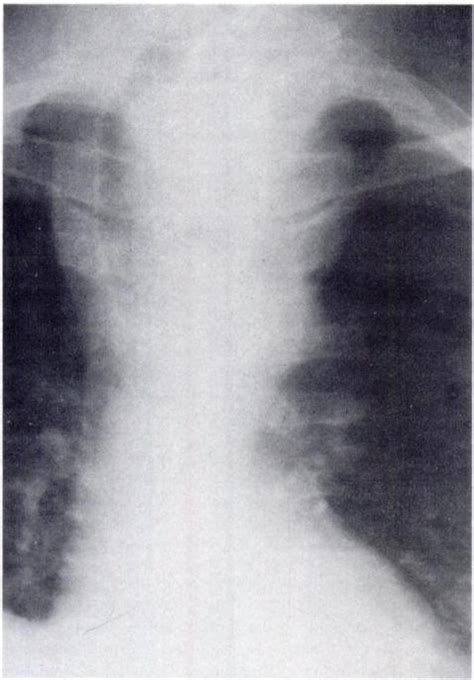 Axillosubclavian Vein Thrombosis Produced By Retrosternal Thyroid Chest