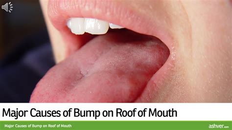 What Could A Lump Or Bump On The Roof Of Your Mouth Be Mccnsulting