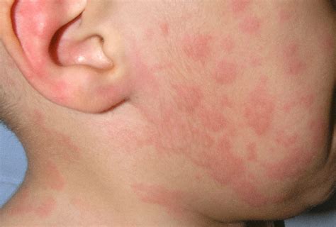 ¿qué Es La Urticaria Clínica De Alergia Pediátrica Expertos En