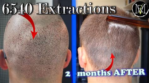Haircut Months After Hair Transplant Donor Area NW A Grafts YouTube