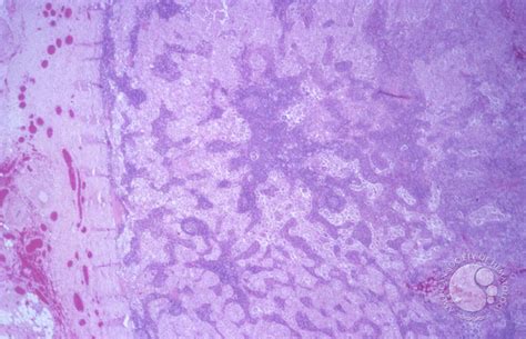 Sinus Histiocytosis With Massive Lymphadenopathy Rosai Dorfman Disease