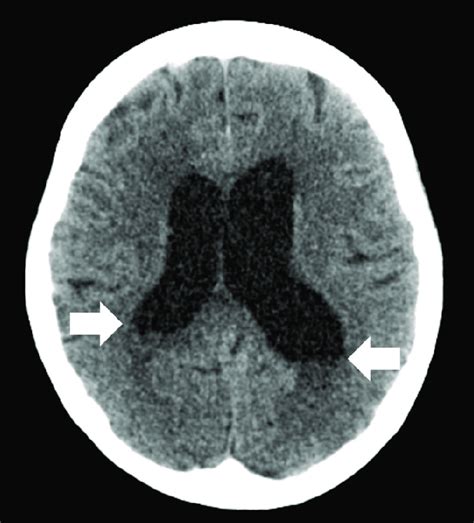 Brain Ct Showed Diffuse Ventriculomegaly With Fluid Level White