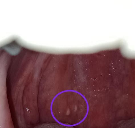 Small White Lumps At Back Of Throat Doc Wasnt Concerned But They Don