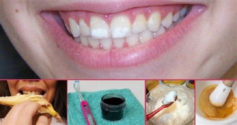 How To Get Rid Of White Spots On Teeth And Keep Them Away