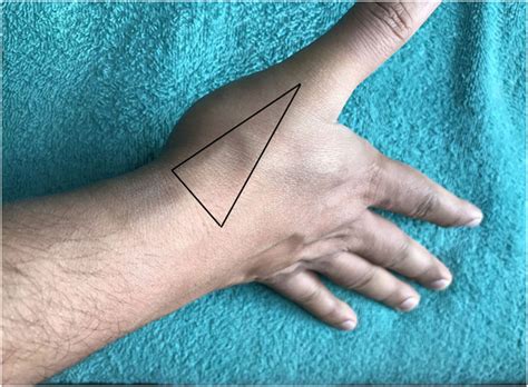 Right Hand In Semi Prone Position Showing A Triangular Depression Download Scientific Diagram