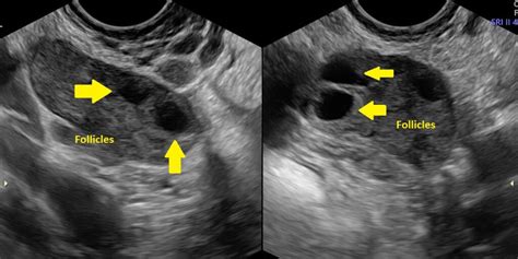 Normal Vs Polycystic Ovaries Ultrasound