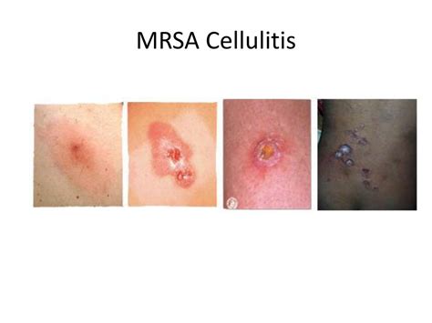 You can take medicine after your vaccination to help with any pain or to lower a fever. PPT - Pediatric Infectious Disease CASE STUDY PHOTOS ...