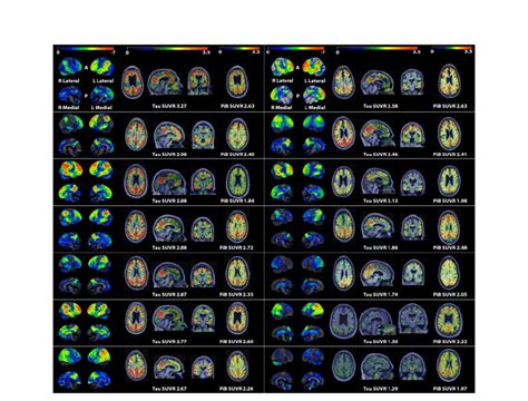 Molecular Neuroimaging And Heterogeneity In Dysexecutive Ad Of The
