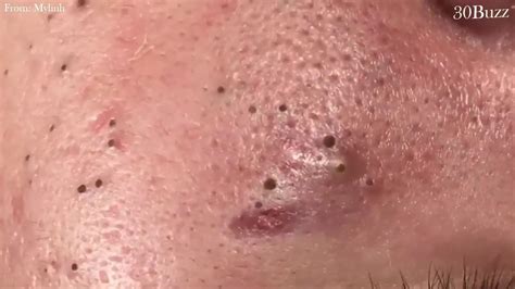 Top Blackheads Removal Of The Month Acne Treatment With Calm Music