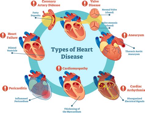 Examples Of Lifestyle Diseases That Can Lead To Cardiovascular Diseases