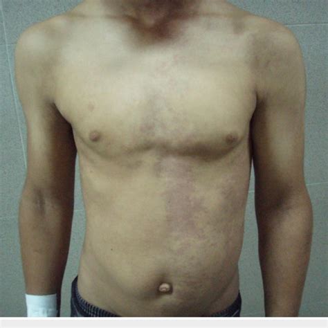 Multiple Cutaneous Port Wine Stains With Telangiectasia On The Left