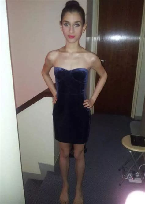 Astonishing Recovery Of Anorexic Girl Who Was Stone When Doctors Told