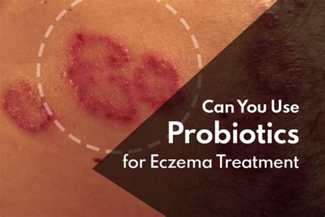 Can You Use Probiotics For Eczema Treatment Truth Revealed