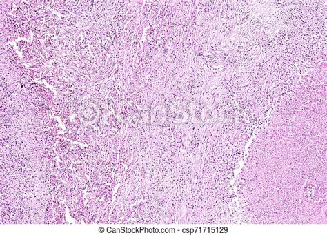 Histology Of Human Tissue Show Spleen Infarction At A Scarring Stage