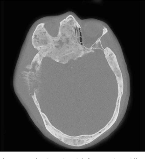 Figure 1 From A Rare Spontaneous Osteosarcoma Of The Calvarium In A