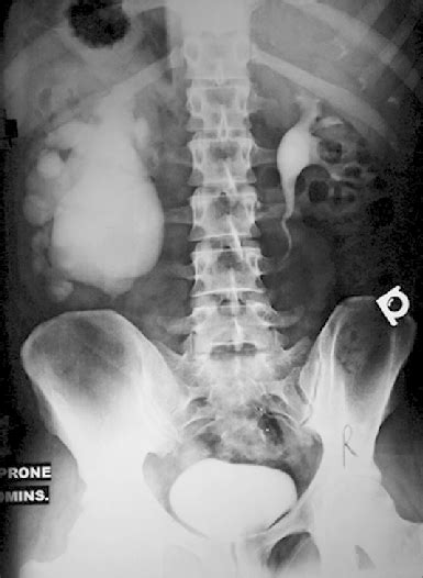 Intravenous Urography Showing Gross Right Hydronephrosis Following A