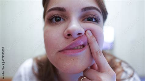 Young Woman With A Sore Lip Aphthous Stomatitis Is A Common Condition