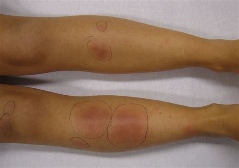 This variety is characterized by formation of red painful lumps under the skin. Erythema nodosum - Wikipedia