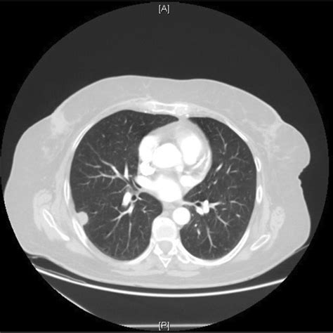 CT Scan Showing Pulmonary Right Lower Lobe Nodule Download Scientific Diagram