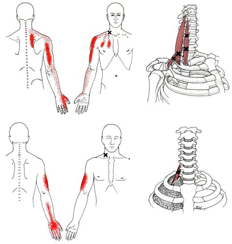 The Trigger Point And Referred Pain Guide 19