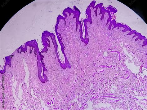Histological Biopsy Of Scrotal Wall Under Microscopy Showing Calcinosis